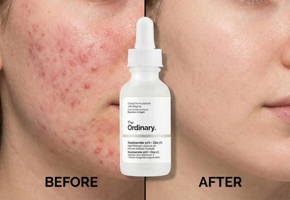 The Ordinary Serum – Buy 1 Get 1 Free